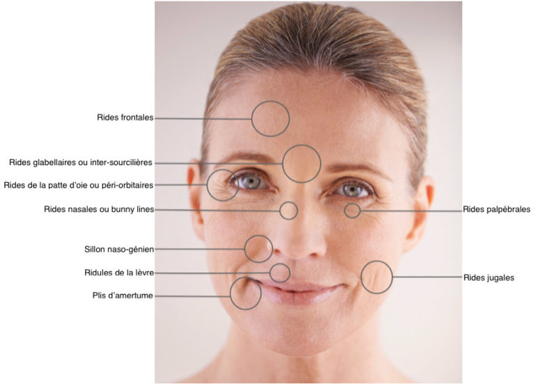 Traitement Des Rides Dr Hecq Mouvaux Médecine Esthétique